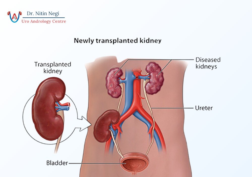 Kidney Transplant in Jaipur